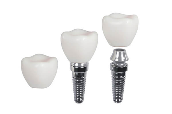 Ceramic dental implant