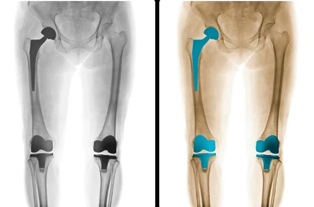 Implantes de rodilla y reemplazos de cadera.