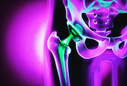 implants orthopédiques
