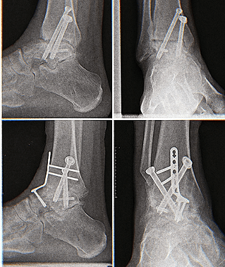 orthopädische Implantate im MRT