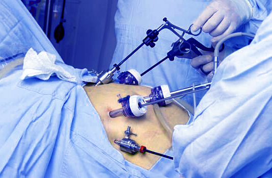 Chirurgie mini-invasive