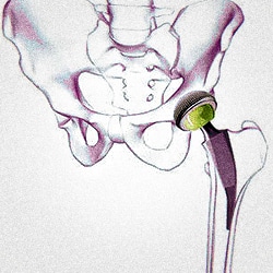 prótesis de cadera